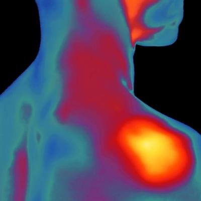 Comment soulager les nœuds musculaires ?