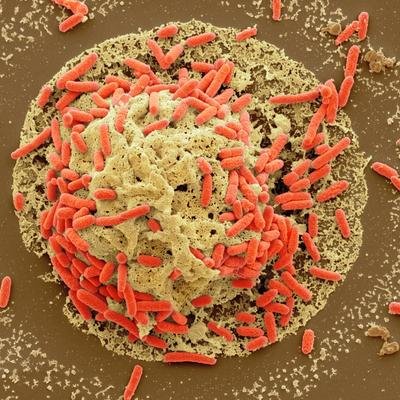 Explosion du cancer colorectal chez les jeunes : une toxine bactérienne en cause ?