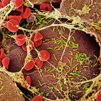 Vaginose bactérienne : cette infection courante qui touche des millions de femmes est en réalité une IST