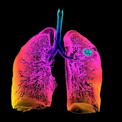 Pourquoi dépiste-on de plus en plus de cancers du poumon chez les non-fumeurs ?