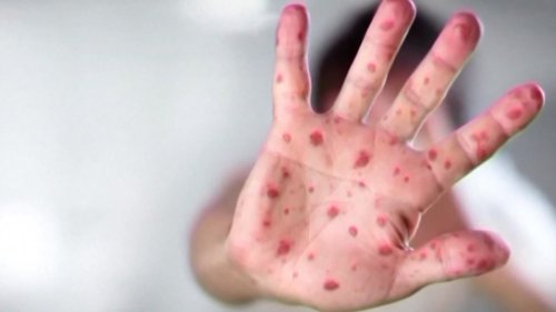 3 measles cases confirmed in North Texas, US tops 1k cases as outbreak spreads to 11 states