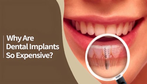 Why are dental implants so expensive? - UAmedTOURS