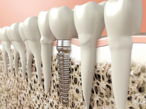 Osteoporosis and dental implants - UAmedTOURS