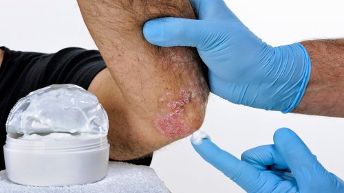 Schuppenflechte (Psoriasis): Symptome, Behandlung und Ursachen