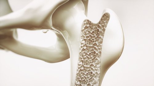 Osteoporose: Symptome erkennen, die richtige Therapie einleiten