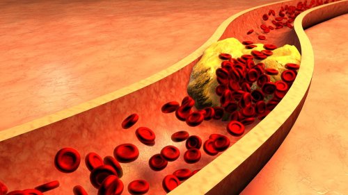 Cholesterin senken: Worauf bei der Ernährung achten?