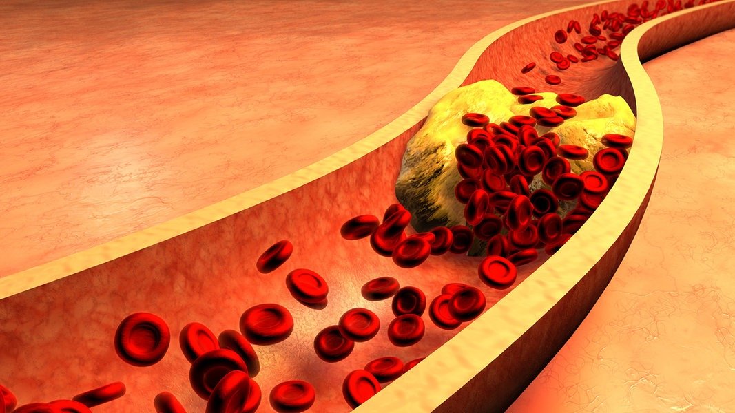 Cholesterin senken: Was Ernährung und Medikamente bringen