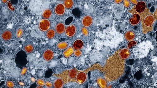 Erster Mpox-Fall in Nordwestmecklenburg bestätigt