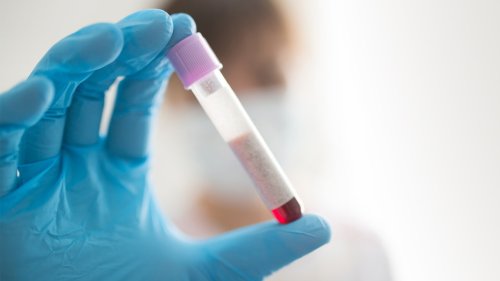 Hypercholesterinämie: Zu hohe Blutfettwerte oft vererbt