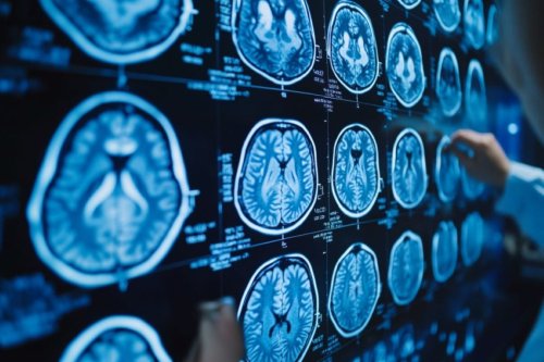 Lower Blood Sugar Diet Linked to Slower Brain Aging