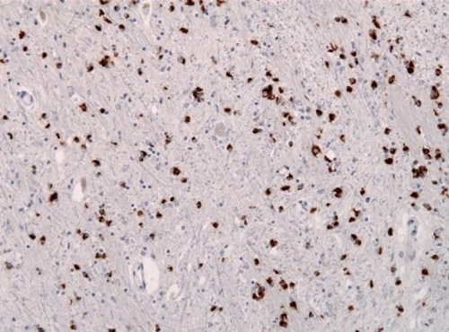 New Human Prion Disease Identified - Neuroscience News