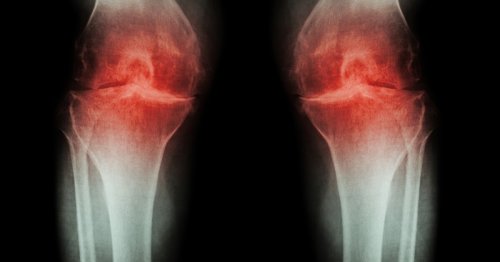 Anti-depressant found to promote healing in osteoarthritic joints