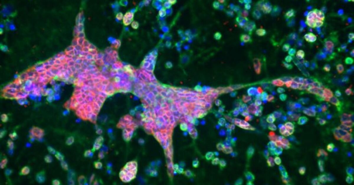 3D brain model offers new evidence linking Alzheimer's to herpes virus