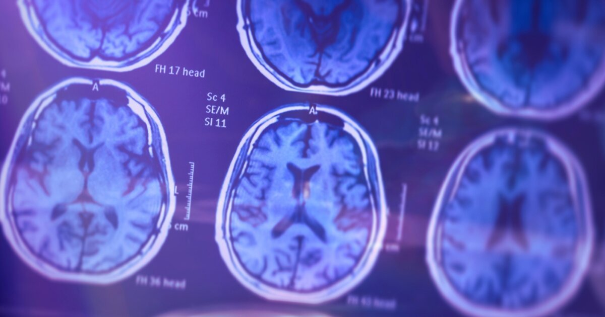 Dementia Signs Detected in Blood Years Before Diagnosis