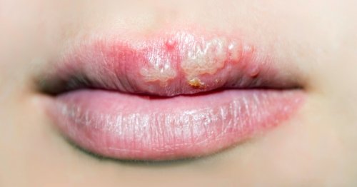 Antiherpes medication use linked to 17% reduced risk of Alzheimer’s