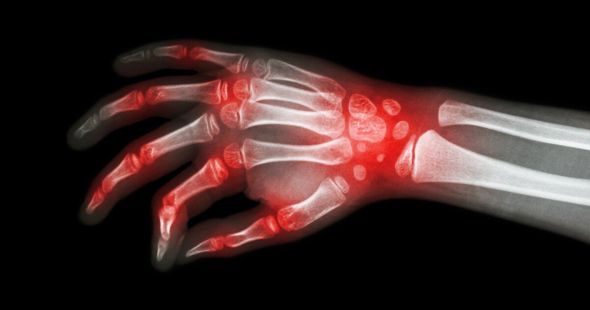 New rheumatoid arthritis drug passes Phase 3 trial, looks to approval
