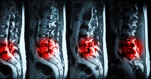 Injectable hydrogel treats back pain from damaged discs in human trials