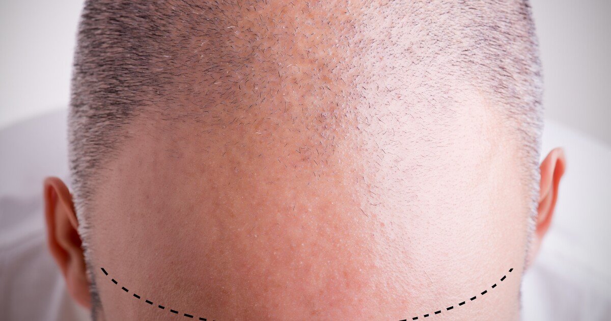 Hair loss breakthrough sees fully mature follicles grown in the lab