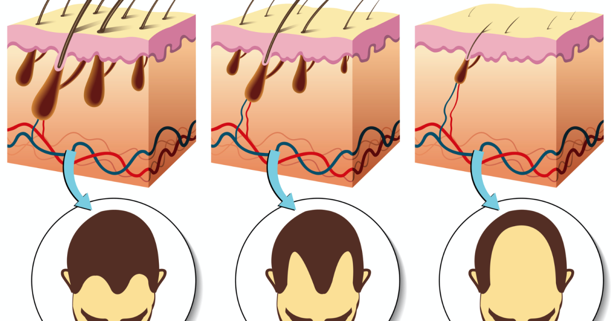 Microneedle patch beats baldness by boosting blood flow to the follicles