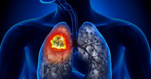 Google's AI for lung cancer diagnosis proves more accurate than radiologists in early trial