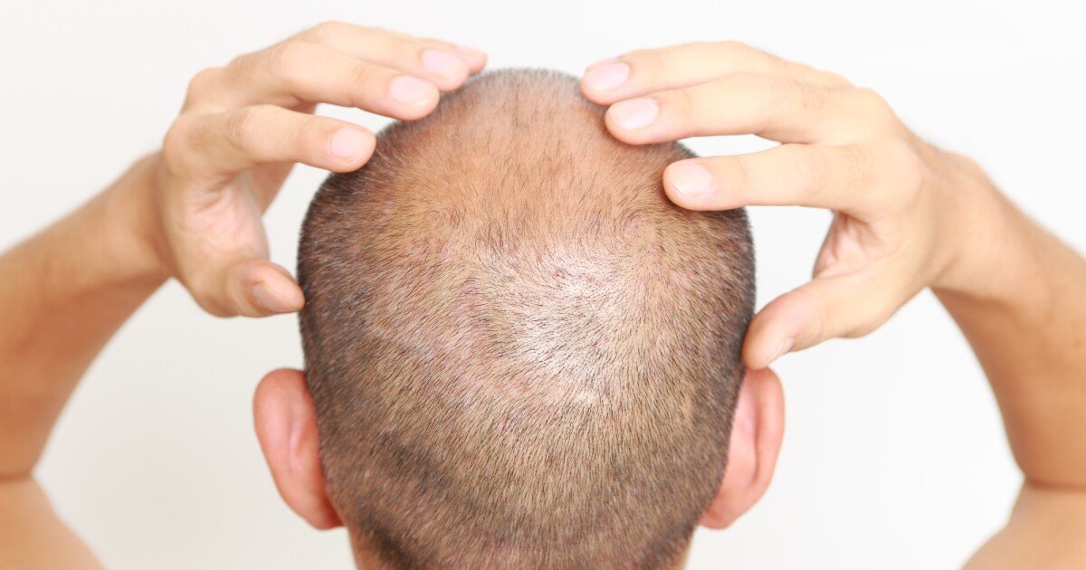 Baldness discovery paints molecule as potent stimulator of new hair growth