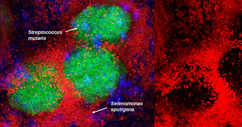 Newly discovered bacterial partnership implicated in dental cavities