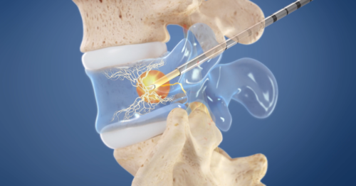 Chronic back pain treatment blocks nerve signals with heat