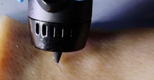 High-tech pen paints healing gel right into wounds