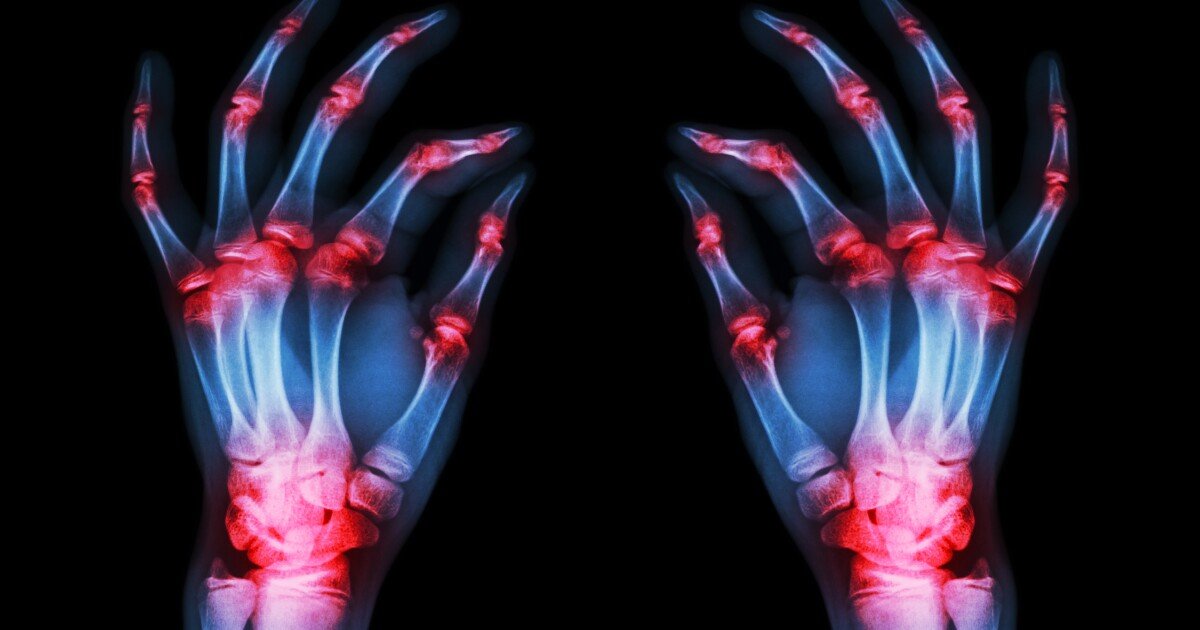 Rheumatoid arthritis protein discovery points to potential new therapy