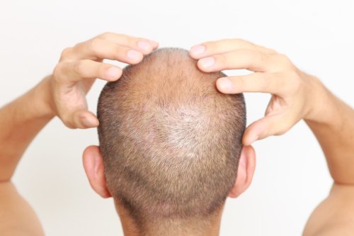Baldness discovery paints molecule as potent stimulator of new hair growth