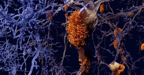 Failed cancer drug may find second life targeting Alzheimer's and dementia