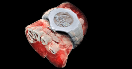 CERN chip enables first 3D color X-ray images of the human body