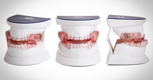 Sleep apnea: Mouthguards less invasive, just as effective as CPAP