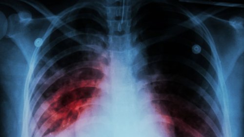 Tuberkulose-Alarm in Chemnitz: Infektionskrankheit breitet sich aus! Schon 25 Menschen infiziert