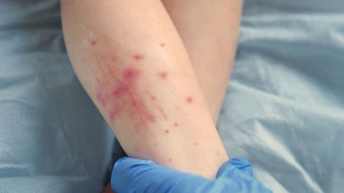 Neuer Mpox-Stamm entdeckt: 10 Prozent der Infizierten sterben - Wissenschaftler warnen vor möglicher Pandemie