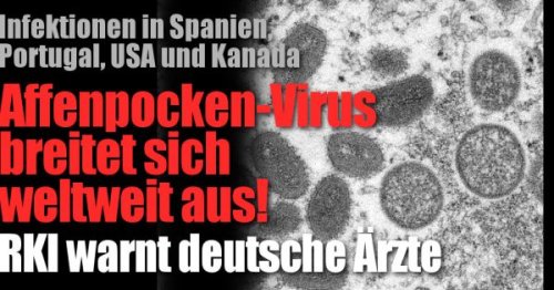 Affenpocken 2022 News aktuell: Irland bestätigt ersten Infektionsfall - "kommt nicht unerwartet"