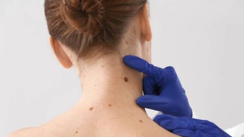 Seborrhoeic Keratosis: All You Need to Know About This Skin Tumour