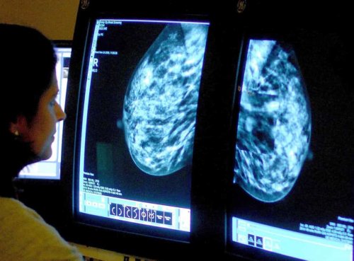New breast cancer treatment not approved for NHS use