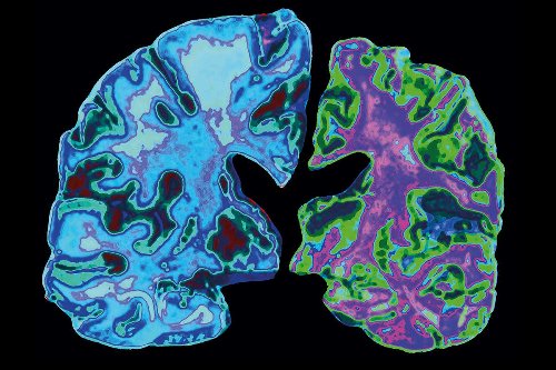 We may finally know what causes Alzheimer’s – and how to stop it