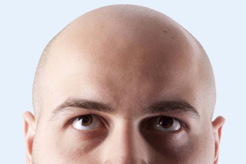 Can we finally reverse balding with these new experimental treatments?