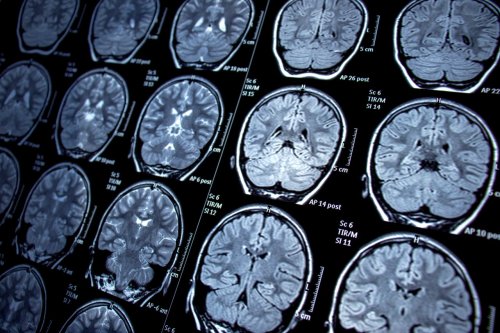 What is an absence seizure?