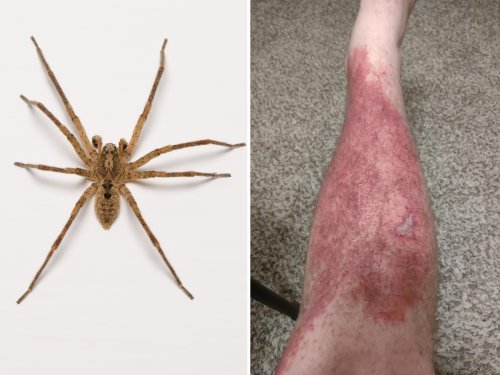 can-a-spider-bite-look-like-a-blister-pestphobia