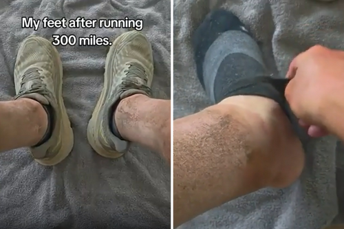 Man Shows What His Feet Look Like After Running 300 Miles in 135 Hours