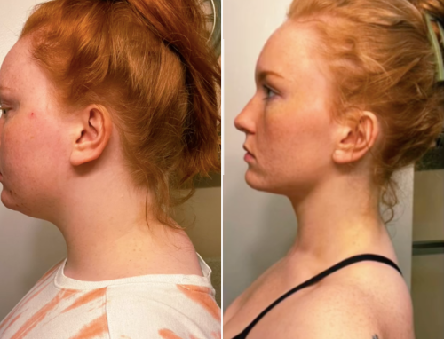 Woman Shares Exercises She Claims Fixed Her 'Tech Neck' in Eight Months