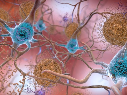 Study: Alzheimer's drug shows modest success slowing declines in memory, thinking