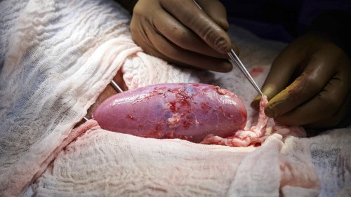 In a major scientific advance, a pig kidney is successfully transplanted into a human