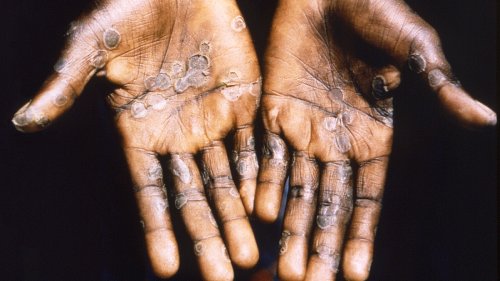 Why the mpox outbreak in the Democratic Republic of Congo is worrying disease docs