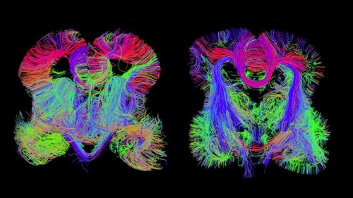 Map Of The Developing Human Brain Shows Where Problems Begin