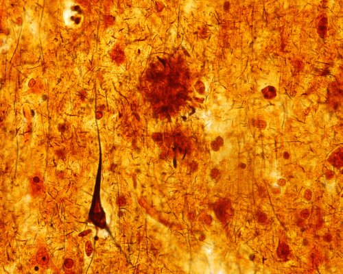New Clues To ALS And Alzheimer's Disease From Physics