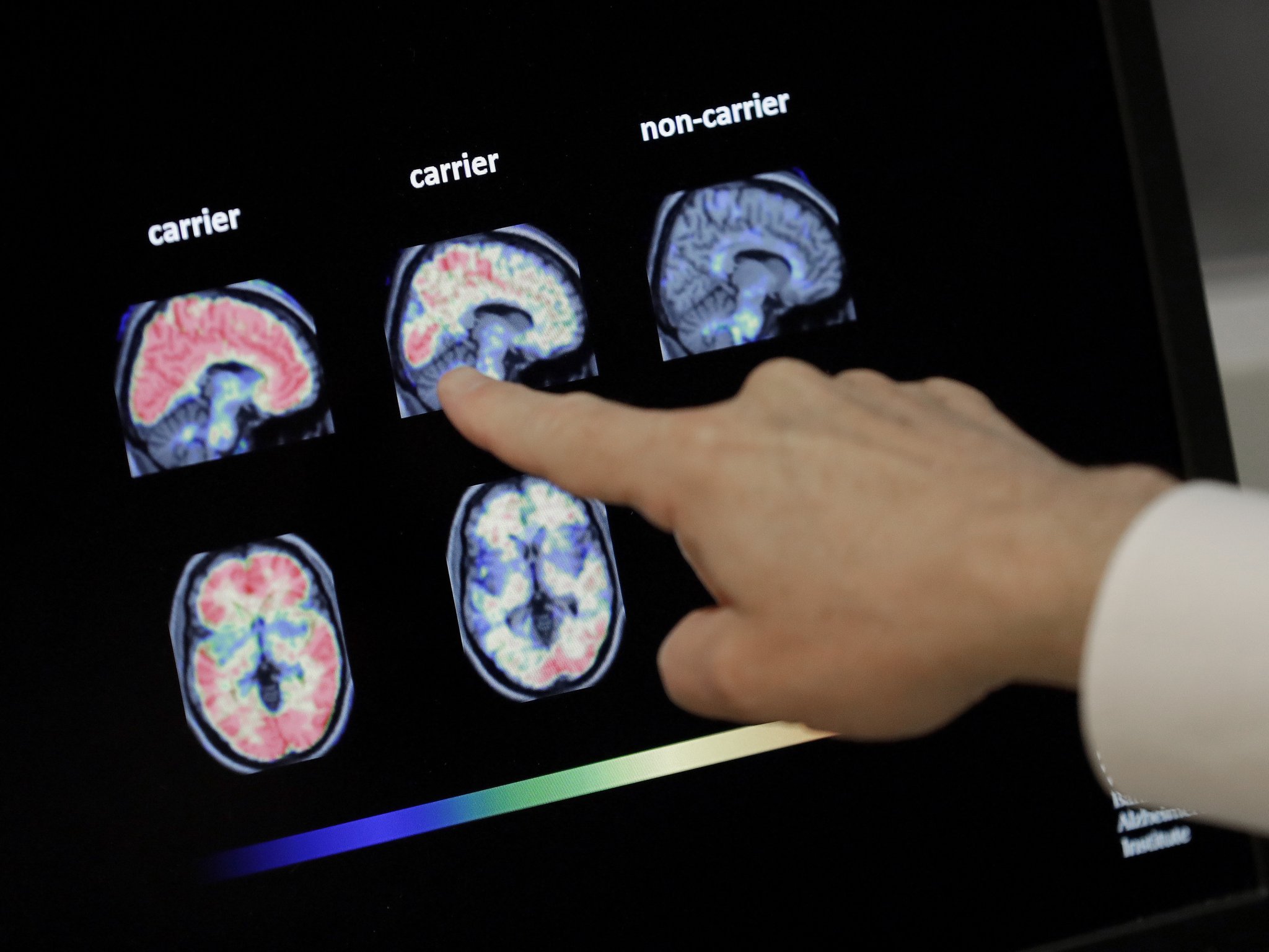 FDA Poised For Decision On Controversial Alzheimer's Drug